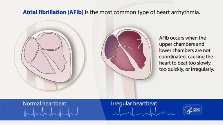 Leia mais sobre o artigo FIBRILAÇÃO ATRIAL (FA)